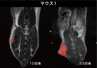 皮下肺腫瘍