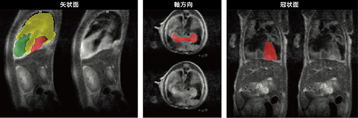 同所性肺腫瘍