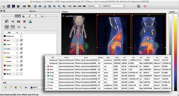 高度な3D ROIツールとセグメンテーション・定量機能